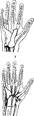 Panaritium: figure 4 from the 1928–1936 encyclopedia article