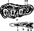 Panaritium: figure 6 from the 1928–1936 encyclopedia article