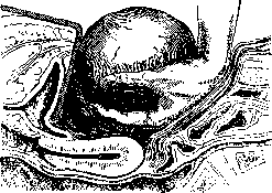 Ovariotomy: figure 7 from the 1928–1936 encyclopedia article