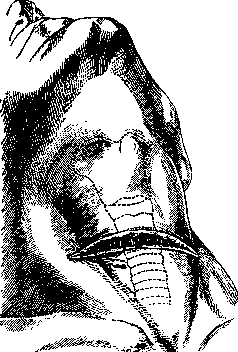 Tracheotomy: figure 1 from the 1928–1936 encyclopedia article
