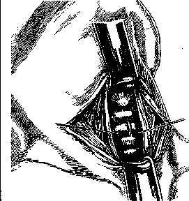 Tracheotomy: figure 4 from the 1928–1936 encyclopedia article