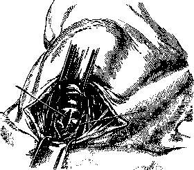 Tracheotomy: figure 7 from the 1928–1936 encyclopedia article