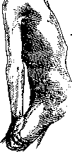 Tabes Dorsalis: figure 2 from the 1928–1936 encyclopedia article