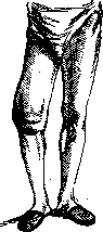 Tabes Dorsalis: figure 1 from the 1928–1936 encyclopedia article