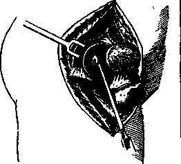 Arthrodesis: figure 1 from the 1928–1936 encyclopedia article