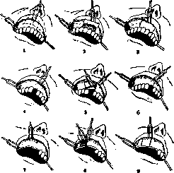 Dental Cysts: figure 1 from the 1928–1936 encyclopedia article