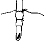 Gastrostomy: figure 2 from the 1928–1936 encyclopedia article