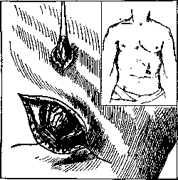 Gastrostomy: figure 3 from the 1928–1936 encyclopedia article