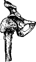 Arthritis: figure 3 from the 1928–1936 encyclopedia article