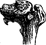 Arthritis: figure 2 from the 1928–1936 encyclopedia article
