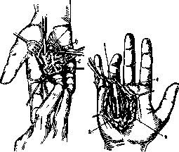 Dupuytren: figure 4 from the 1928–1936 encyclopedia article