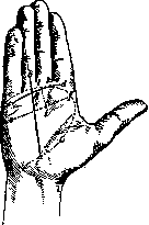 Dupuytren: figure 3 from the 1928–1936 encyclopedia article