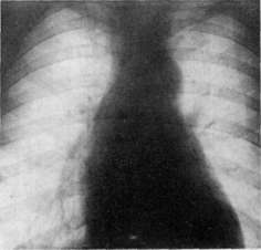 Myelography: figure 1 from the 1928–1936 encyclopedia article