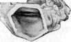 Dermographism: figure 8 from the 1928–1936 encyclopedia article
