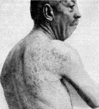 Dermographism: figure 3 from the 1928–1936 encyclopedia article