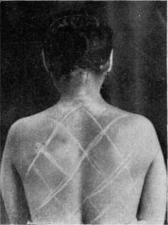 Dermographism: figure 1 from the 1928–1936 encyclopedia article