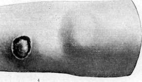 Dermographism: figure 10 from the 1928–1936 encyclopedia article