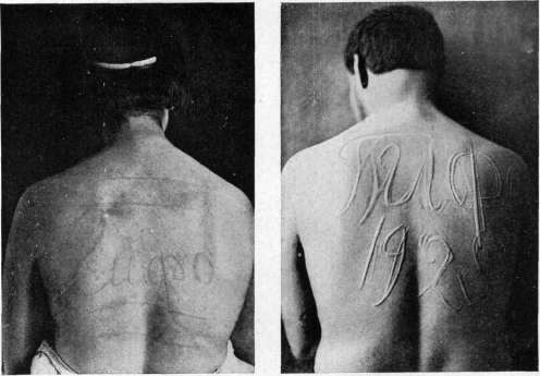 Dermographism: figure 2 from the 1928–1936 encyclopedia article