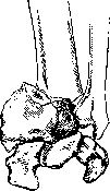 Preoperative Period: figure 4 from the 1928–1936 encyclopedia article