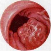 Gastroscopy: figure 7 from the 1928–1936 encyclopedia article