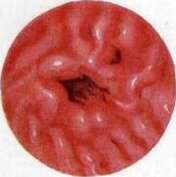 Gastroscopy: figure 6 from the 1928–1936 encyclopedia article