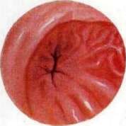 Gastroscopy: figure 4 from the 1928–1936 encyclopedia article