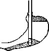 Gastroscopy: figure 2 from the 1928–1936 encyclopedia article