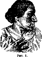 Acromegaly: figure 1 from the 1928–1936 encyclopedia article