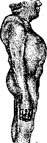 Acromegaly: figure 2 from the 1928–1936 encyclopedia article