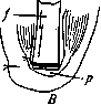 Gritti's Amputation: figure 2 from the 1928–1936 encyclopedia article