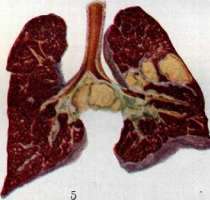 Pulmonary Tuberculosis: figure 11 from the 1928–1936 encyclopedia article