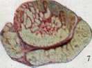 Pulmonary Tuberculosis: figure 13 from the 1928–1936 encyclopedia article