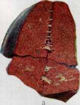 Pulmonary Tuberculosis: figure 9 from the 1928–1936 encyclopedia article