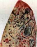 Pulmonary Tuberculosis: figure 10 from the 1928–1936 encyclopedia article