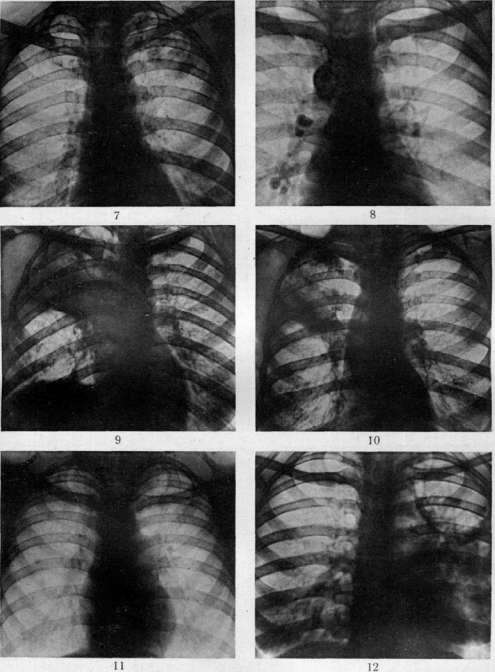 Pulmonary Tuberculosis: figure 17 from the 1928–1936 encyclopedia article