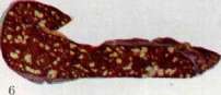 Pulmonary Tuberculosis: figure 12 from the 1928–1936 encyclopedia article