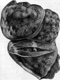 Pulmonary Tuberculosis: figure 6 from the 1928–1936 encyclopedia article