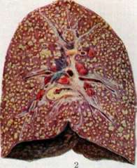 Pulmonary Tuberculosis: figure 8 from the 1928–1936 encyclopedia article