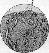 Pulmonary Tuberculosis: figure 3 from the 1928–1936 encyclopedia article