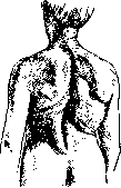 Lordosis: figure 9 from the 1928–1936 encyclopedia article