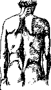 Lordosis: figure 2 from the 1928–1936 encyclopedia article