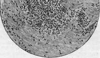 Typhus Fever: figure 4 from the 1928–1936 encyclopedia article