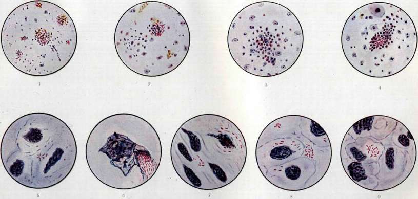 Typhus Fever: figure 2 from the 1928–1936 encyclopedia article
