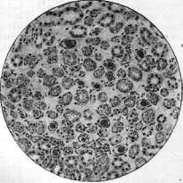 Typhus Fever: figure 5 from the 1928–1936 encyclopedia article