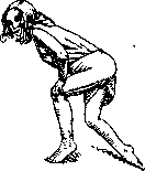 Dystrophy: figure 2 from the 1928–1936 encyclopedia article
