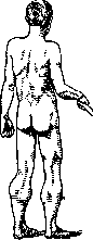 Dystrophy: figure 5 from the 1928–1936 encyclopedia article