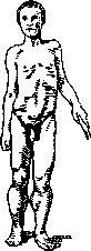 Dystrophy: figure 6 from the 1928–1936 encyclopedia article