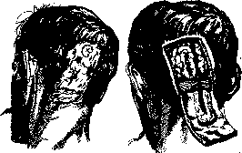 Wounds: figure 4 from the 1928–1936 encyclopedia article