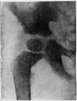 Tuberculosis: figure 10 from the 1928–1936 encyclopedia article