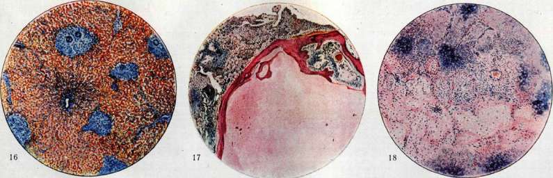 Tuberculosis: figure 4 from the 1928–1936 encyclopedia article